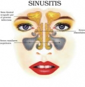 Atendemos sinusitis - Dr. Alejandro Ortiz Domínguez - Otorrinolaringólogo