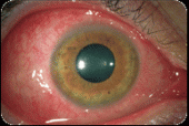 Cirugías de ojos - Cirujano Oftalmólogo - Dr. Jorge R. Peña Calleja