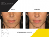 Rejuvenecimiento facial avanzado - Beleco - Medicina Estética
