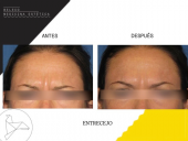 Elimina las líneas de expresión - Beleco - Medicina Estética