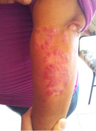 psoriasis  antes del tratamiento en brazos - Bariatra en Puebla - Dr. Alejandro Domínguez Díaz - Med...