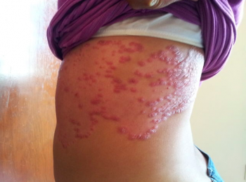 psoriasis antes del tratamiento  en cuerpo - Bariatra en Puebla - Dr. Alejandro Domínguez Díaz - Med...