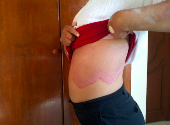 psoriasis 4ta sesión despúes - Bariatra en Puebla - Dr. Alejandro Domínguez Díaz - Medicina Biológic...