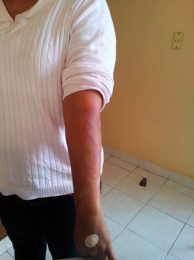 psoriasis tratamiento en puebla - Bariatra en Puebla - Dr. Alejandro Domínguez Díaz - Medicina Bioló...
