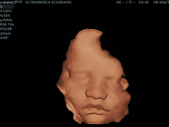 El ultrasonido 4D, se recomienda realizarse entre la semana 25 y 32 de gestación, para visualizar fa...