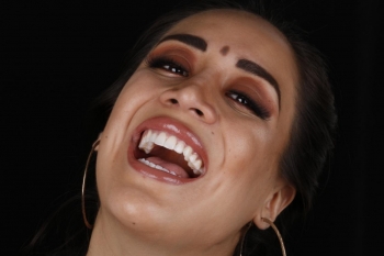 carillas dentales son piezas de porcelana ó cerámica  - SmileCare Clínica Dental de Especialidades -...