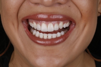 Carillas dentales SmileCare  - SmileCare Clínica Dental de Especialidades - Puebla