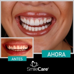 La sonrisa de tus sueños, caso de éxito de Carilla Dentales - SmileCare Clínica Dental de Especialid...