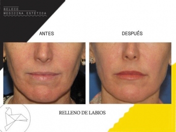 Beleco - Medicina Estética - Puebla