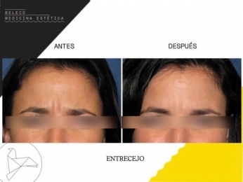 Beleco - Medicina Estética - Puebla