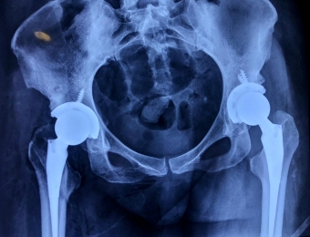 Secuelas de enfermedades de la niñez como Perthes tratado con artroplastía - Ortopedista - Dr. Crist...