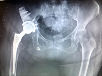 Reconstruccion avanzada por osteolisis - Ortopedista - Dr. Cristian Rivera Reyes - Puebla