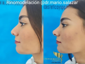 Cirugía estética y Bariatría en Puebla - Dr. Mario Salazar Olivares - Puebla